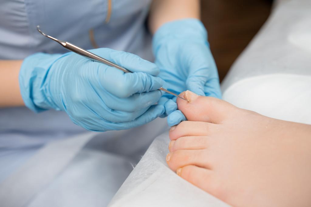 Ingrown Toenail Workshop